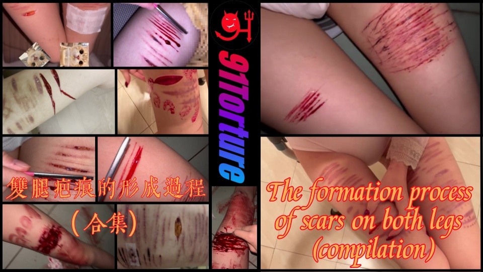 双腿疤痕的形成过程（合集）